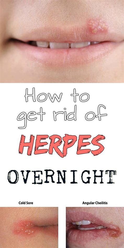 beyonce herpes|Oral Herpes, Genital Herpes, and Celebrities (Oh My!).